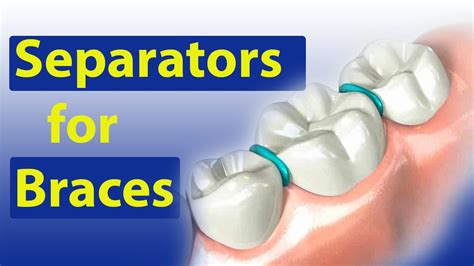 spacers for metal brackets teeth|metal separator orthodontics.